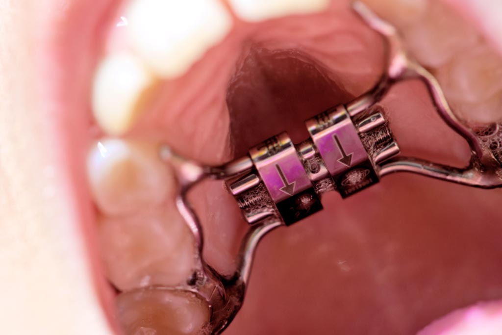 imgi 1 aparatos fijos galvan dental kids